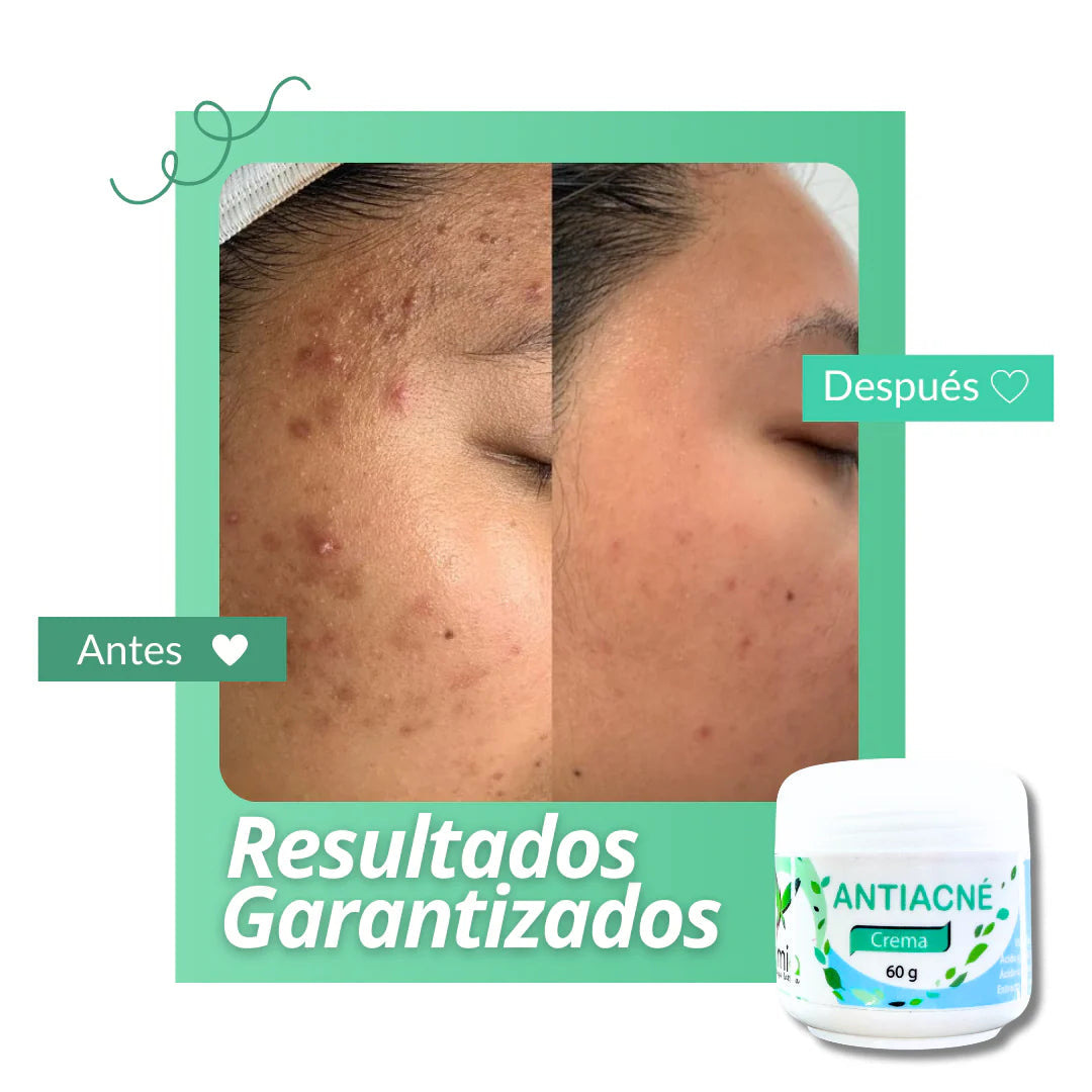ZAMIA Crema Antiacné ORIGINAL